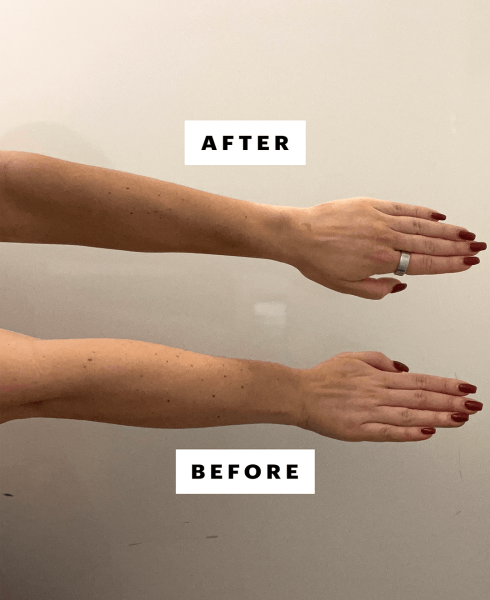 A photo of the writer's right arm  untanned and left arm  tanned after two hours